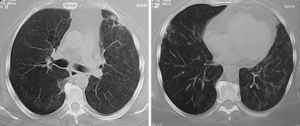 a y b)Mismo paciente de figura 4 tras 4meses de tratamiento con inmunomoduladores. Se observa la desaparición de las masas y de los nódulos; solo persisten bandas fibrosas y parches focales de fibrosis.