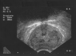 Imagen prostática mediante ecografía transrectal, donde se visualizan áreas hipoecoicas difusas.