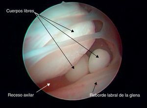 Imagen artroscópica, identificando cuerpos libres intraarticulares de la condromatosis sinovial.