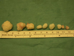 Retirada de 9 cuerpos libres. Obsérvese el tamaño comparativo con la regla asociada en la imagen.