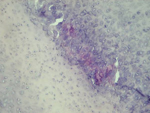 Imagen histológica. Metaplasia condroide asociada a cristales débilmente birrefringentes y células gigantes multinucleadas.