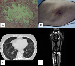 A) Biopsia de piel de región glútea con granuloma de cuerpo extraño con calcificaciones, proliferación vascular, necrosis y zonas de esclerosis. B) Necrosis superficial en piel, región glútea, vista lateral derecha. C) TC-AR de tórax simple, enfisema panlobulillar. D) TC simple de miembros inferiores, lesiones nodulares confluentes hiperdensas en ambos glúteos y diseminadas hacia el muslo y la pierna en región posterior, sugiere calcificaciones.