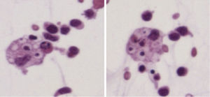 Líquido ascítico. Se observan macrófagos con glóbulos rojos en su interior.