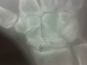 Radiografía de mano derecha en la que se observa colapso del escafoides, con signos de atrosis (flecha).