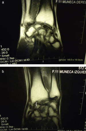 A) RM imagen coronal T1WI (TR 432, TE 26). Fractura del escafoides derecho con necrosis del fragmento proximal, marcadamente hipointenso (flecha), con cambios degenerativos crónicos por inestabilidad. B) RM imagen coronal T1WI (TR 432, TE 26). Fractura del escafoides izquierdo, sin consolidación ni cambios en el patrón de señal del fragmento proximal, con cambios degenerativos crónicos por inestabilidad (flecha).