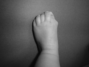 La displasia del primer metatarsiano con deformidad en hallux valgus es el rasgo constitucional más característico de la FOP. Su correcta identificación desde el nacimiento es de gran importancia diagnóstica y evita procedimientos potencialmente dañinos.