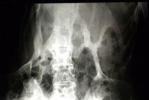 Gruesas bandas de hueso heterotópico de aspecto lamelar maduro (patrón de osificación endocondral) que forman de puentes rígidos entre diversas estructuras y acaban formando un verdadero «segundo esqueleto».