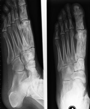 Radiografía lateral y anteroposterior de pie izquierdo con engrosamiento del metatarsiano y falanges del primer dedo derecho.