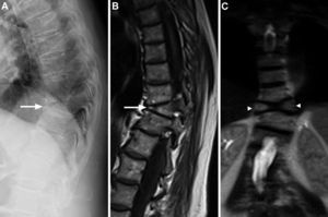 Radiografía lateral de columna dorsal mostrando un aparente aplastamiento vertebral cuneiforme anterior de D10 (A, flecha). La RM mostraba en los cortes sagitales de la secuencia potenciada en T1 un acuñamiento anterior similar al observado en la radiografía (B, flecha), pero en los cortes coronales se evidenció que en realidad correspondía a un defecto de fusión del cuerpo vertebral, que originaba la presencia de 2 hemivértebras, la derecha ligeramente menor que la izquierda, con la apariencia típica de «vértebra en mariposa» (C, cabezas de flechas).