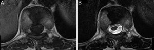 Cortes axiales de RM obtenidos a nivel de D10 en secuencias potencias en T1 (A) y T2 (B), que confirman la presencia del defecto anterior, con pedículos y láminas no afectados, y ausencia de compresión de canal.