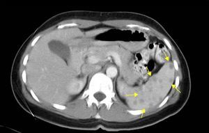 TAC abdominal con contraste con múltiples lesiones esplénicas sin captación de contraste (flechas).