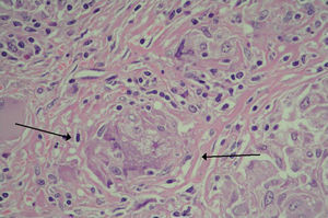 Histología microscópica esplénica con presencia de granuloma no caseificante (flechas).