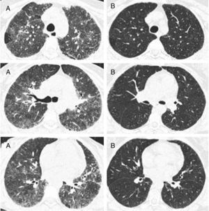 Representative images of HRCT scan after and before treatment with prednisone and DMARDs. (A) Basal HRCT images, showing bilateral ground-glass images, centroliobular nodules and lobular areas of decreased attenuation. (B) There is a general improvement of the ground glass and no images of centroliobular nodules and lobular areas of decreased attenuation. The patient was treated with prednisone, methotrexate and sulphasalazine. There is a difference of 16 months between basal HRCT (A) and follow-up HRCT (B).