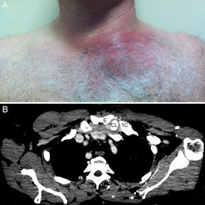 Caso 5. A: aspecto externo. B: TC torácica alta, con la articulación esternoclavicular mostrando distensión capsular y contenido inflamatorio en su interior. C: clavícula; E: esternón; 1C: primera costilla.