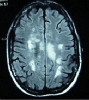 Resonancia magnética de cráneo en secuencias T2 y FLAIR, con presencia de múltiples lesiones en la sustancia blanca a nivel corticosubcortical, periventricular, periauriculares y en corona radiada derecha. Lesión de mayor tamaño desde el brazo posterior de la cápsula interna derecha hasta el pedúnculo mesencefálico derecho.