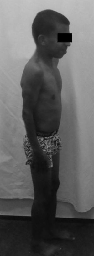 Paciente con síndrome de Noonan (talla baja, cuello corto, deformidad torácica).