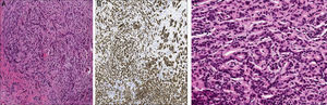 A. Hematoxilina-eosina (4×); se observan células tumorales de núcleos hipercromáticos. B. En la tinción de inmunohistoquímica (4×) las células conservan la expresión de E-cadherina, rodeadas de un estroma desmoplásico. C. A mayor aumento (20×) se distinguen en otras áreas de cilindro formación de esbozos de glándulas que infiltran el intersticio, el cual es fibroso y con reacción inflamatoria.