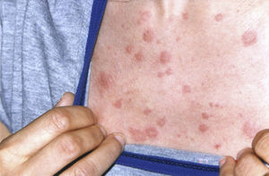 Lesiones máculo-papulares eritematosas, no dolorosas ni pruriginosas a nivel de tronco.