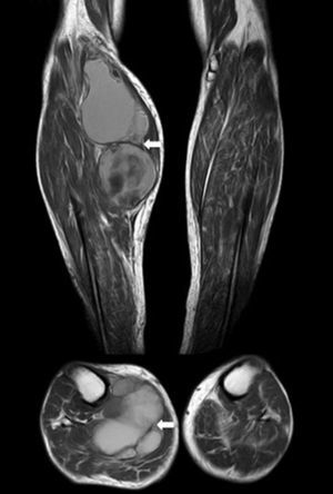 RM. Imágenes axial y coronal en T1. Masa bien circunscrita (flechas). Aumento de la intensidad de señal compatible con presencia subaguda de productos sanguíneos.