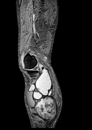 RM. Imagen STIR sagital. El hematoma muestra aumento difuso de la intensidad de la señal.