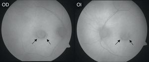 Retinografía con autofluorescencia de la paciente en el momento del diagnóstico de maculopatía por antipalúdicos. Se aprecia una alteración pigmentaria macular concéntrica incompleta (flechas).OD: ojo derecho; OI: ojo izquierdo.
