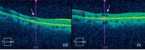 Tomografía de coherencia óptica de las máculas de la paciente en el momento del diagnóstico. Signo de «platillo volante» típico de la maculopatía cloroquínica (flechas).