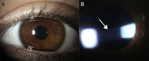 A) Ojo con uveítis anterior crónica asociada a AIJ sin mostrar evidencia de inflamación a simple vista. B) Mismo ojo bajo lámpara de hendidura mostrando fenómeno de Tyndall (exudación proteica) y células inflamatorias (flecha) flotando en el humor acuoso de la cámara anterior.