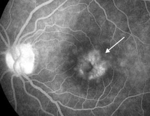 Fluorangiografía de retina (fase tardía) de ojo izquierdo de paciente con edema macular quístico crónico (flecha) por uveítis crónica secundaria a AIJ.