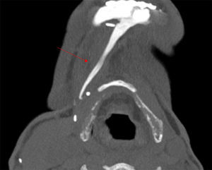 Proyección axial maximum intensity projection (MIP): muestra la calcificación lineal anormal.