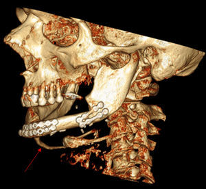 Imagen en reconstrucción 3 D que muestra el trayecto de la calcificación anormal.