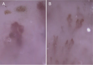 La capilaroscopia puso de manifiesto hemorragias en múltiples áreas, 2 trombosis y capilares de gran tamaño (A), así como megacapilares, dilataciones moderadas-severas alternando con zonas de dilataciones mínimas y tortuosidades simples (B), sin áreas avasculares.