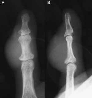 Radiografía simple en proyecciones AP (A) y lateral (B), observándose un aumento de densidad de partes blandas correspondiente a la lesión, con indemnidad de las falanges.