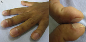 Digital clubbing. (A) Clubbed appearance of distal phalanges. (B) Positive Schamroth
