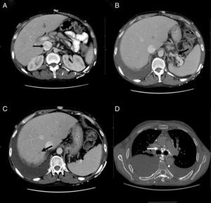 A) Tomografía computarizada, corte axial: muestra heterogenicidad de la vena cava inferior. B) Tomografía computarizada, corte axial: muestra circulación colateral en el hilo esplénico. C) Tomografía computarizada, corte axial: muestra defecto de repleción suprahepática. D) Angiotomografía, corte axial: muestra circulación colateral mediastínica.