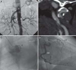 A) Aortografía abdominal evidenciando estenosis proximal a nivel de ambas arterias renales (punta de flecha). B) Angiografía por tomografía computarizada donde se observa disección de la arteria carótida izquierda (punta de flecha). C) Coronariografía izquierda (oblicua anterior izquierda) donde únicamente se ve una arteria circunfleja de escaso desarrollo (punta de la flecha). D) Coronariografía derecha (oblicua anterior derecha) donde se evidencia una coronaria derecha (CD) dominante que rellena por circulación colateral de la descendente anterior (DA), que se encuentra ocluida a nivel proximal.