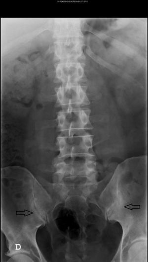 Radiografía columna lumbar AP: Se observa esclerosis e irregularidad de las articulaciones sacroilíacas mayor en derecha, compatible con sacroileítis (flechas) grado III izquierdo y II derecho.