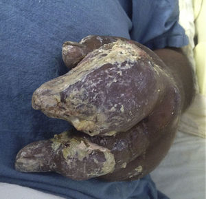 Tofos con presencia de piel ulcerada y de exudado con aspecto de «arcilla blanca».