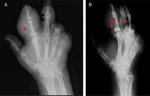 A) Radiografía dorsopalmar de mano izquierda. B) Radiografía lateral de mano izquierda. En ambas se aprecia aumento de volumen en tejidos blandos en segundo y tercer dedo correspondientes con tofo (*), en los tejidos óseos resalta la presencia de erosiones en borde colgante (flechas), con pérdida de espacio articular.