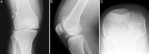 Estudio radiográfico de la rodilla derecha. A) Vista anteroposterior en la que se aprecian 2 fragmentos (flechas). B) Vista lateral. Las flechas apuntan al fragmento que con mayor probabilidad originó la hemartrosis. C) Rodilla en hiperflexión que permite localizar el mayor de los fragmentos en relación con el eje axial de la rodilla.