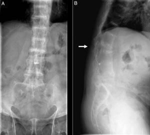 A) Calcificación de los discos intervertebrales, fusión de los cuerpos vertebrales, esclerosis difusa vertebral, puente óseo en sínfisis de pubis. B) Calcificación de los discos intervertebrales, fusión de los cuerpos vertebrales con esclerosis difusa, fractura vertebral de la tercera vértebra lumbar (flecha).