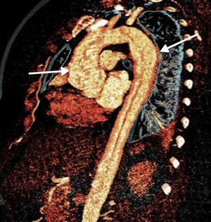 Reconstrucción aórtica mediante resonancia magnética destacando zona de dilatación aórtica en el cayado. Paciente con sialoadenitis por IgG4 con afección aórtica.
