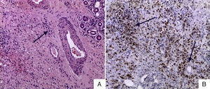 A) Glándula lagrimal teñida con hematoxilina y eosina, 40×: infiltración de células plasmáticas periglandular con distorsión glandular. B) Inmunohistoquímica de glándula lacrimal IgG4+, índice IgG/IgG4 >40%.