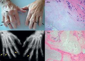 Exploración física de las manos. A) Tofos en articulaciones interfalángicas y metacarpofalángica. B) Radiografía simple de las manos. Tofos y signos de artrosis en articulaciones interfalángicas. Muestra anatomopatológica de un tofo con tinción hematoxilina/eosina a 60 y 10 aumentos.