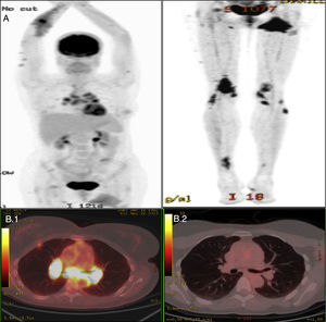 Estudio de medicina nuclear del caso 1. A) Estudio gammagráfico con proceso inflamatorio activo que afecta a las extremidades superiores e inferiores, ganglios mediastínicos, parénquima pulmonar, hueso y músculo del glúteo izquierdo. B.1) Estudio PET con afectación ganglionar mediastínica antes del tratamiento. B.2) Estudio PET después del tratamiento.
