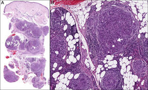A) HE ×40: múltiples granulomas desnudos predominantemente en el tejido celular subcutáneo. B) HE ×400: granulomas ocupando principalmente los lobulillos con algunas células de Langerhans aisladas (flecha).