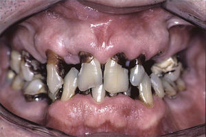 Paciente con hiposialia por SSp y gran número de caries.