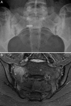 Caso 1. A) Radiografía de sacroiliacas con ensanchamiento, erosiones y esclerosis bilateral, que corresponde a una sacroilitis grado 3 bilateral. B) RM de sacroiliacas con esclerosis, erosiones y marcado edema óseo demostrativo de sacroilitis activa.
