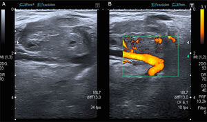 A) Imagen iso/hipoecogénica en escala de grises, redondeada, heterogénea y moderadamente delimitada. B) Imagen con señal Doppler activa que muestra el vaso que nutre la lesión metastásica.