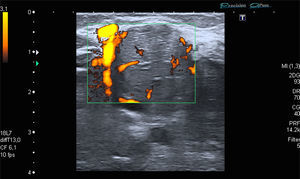 Imagen con señal Doppler que muestra una imagen redondeada y señal grado i en la lesión e hipervascularización por presencia de un vaso adyacente.