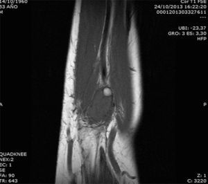 RM, corte sagital de antebrazo en T1. Masa iso/hiperintensa redondeada, bien delimitada, en el músculo del antebrazo derecho, con signo de desplazamiento con saturación grasa.
